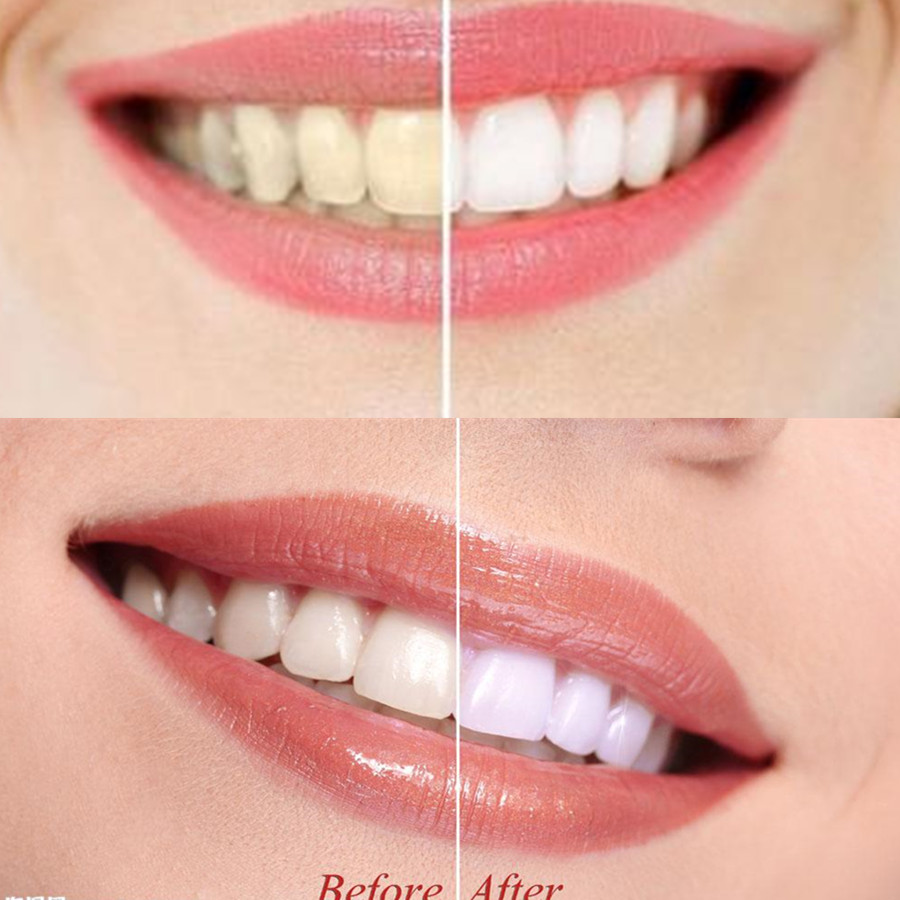 대나무 숯 치아 치아 Dentis Lab 구강 위생 관 - Teeth Whitening Filter 리뷰 및 가격