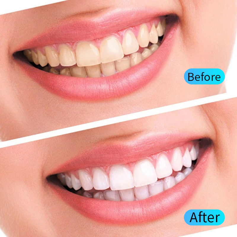 치아 미백 젤 키트 구강 위생 관리 치아 미백 도구 필 - Teeth Whitening Filter 리뷰 및 가격