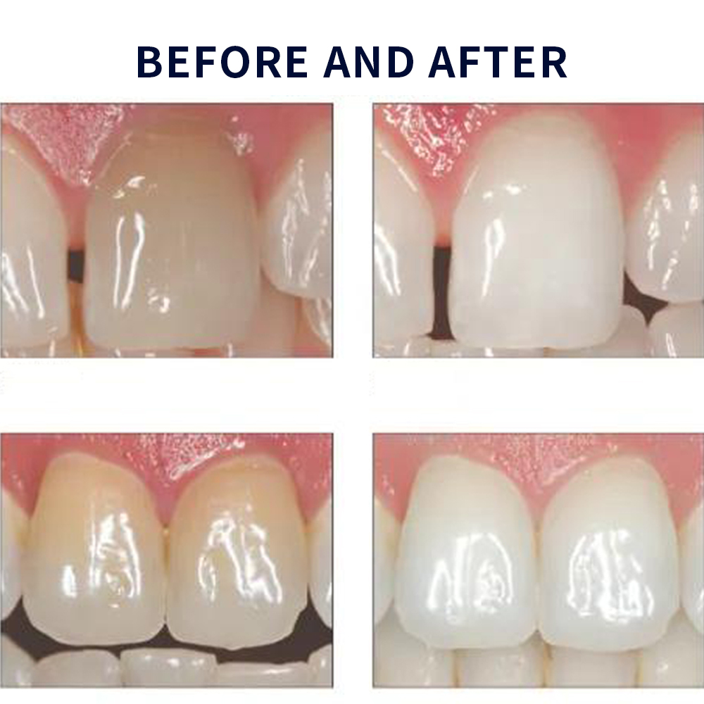 유백광 미백 20% PF 20 16 젤 키트, 초강력  - Teeth Whitening Before And After 리뷰 및 가격
