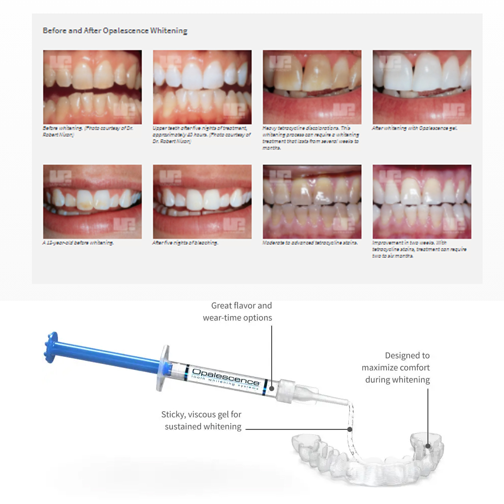 유백광 미백 20% PF 20 16 젤 키트, 초강력  - Teeth Whitening Before And After 리뷰 및 가격
