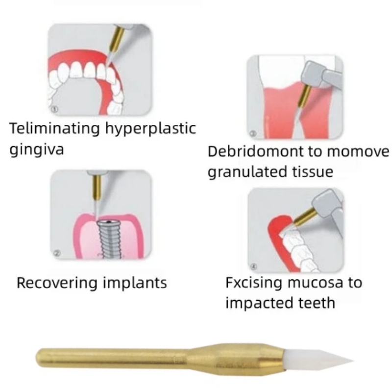 치과용 소프트 트리머 버 수술용 잇몸 견인기 과다성 잇 - Teeth Whitening Gum 리뷰 및 가격